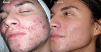 before-after-acne before-after-acne