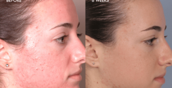 before-after-acne-two before-after-acne-two