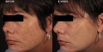 before-after-melasma before-after-melasma